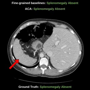 Representative image for Anatomy Contextualized Adaption of CT Foundation Models