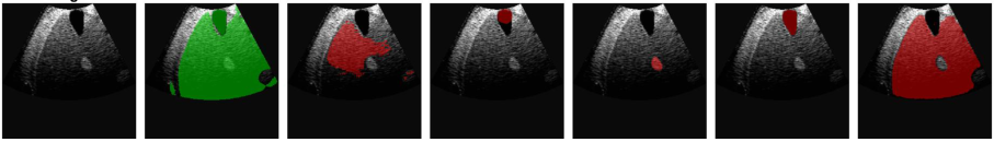Representative image for UltraSAM3: A Concept-Driven Foundation Model for Universal Ultrasound Image Segmentation